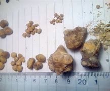 Image result for 6 mm Kidney Stone