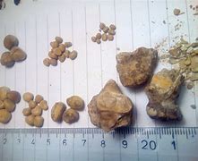 Image result for 2 mm Stone in Left Kidney