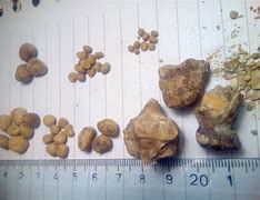 Image result for 18 mm Kidney Stone