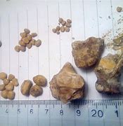 Image result for What Do Kidney Stones Look Like