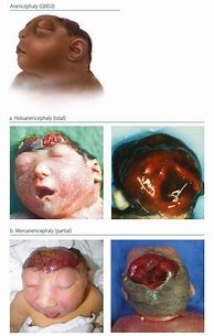 Image result for Exencephaly vs Anencephaly