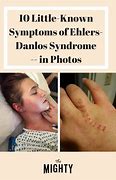 Image result for Ehlers-Danlos Syndrome Symptoms