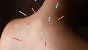 Image result for acupuntuda