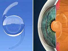 Image result for Multifocal Intraocular Lens Design