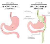 Image result for Bypass Weight Loss Surgery