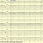 Image result for Ciganek EEG