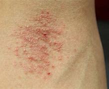 Image result for Adult Skin Conditions