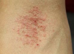 Image result for What Does Mild Eczema Look Like