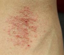 Image result for Eczema Symptoms