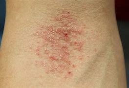 Image result for Eczema