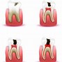 Image result for Calcified Plaque Teeth