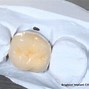 Image result for Dental Crown On Molar