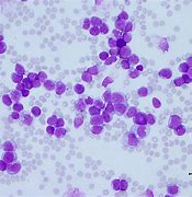 Image result for Leukemia Cancer