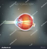 Image result for Astigmatism