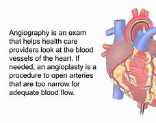 Image result for Angioplasty vs Bypass