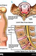 Image result for L5-S1 Lumbar Spine Anatomy