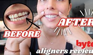 Image result for Byte Teeth Aligners Progess Pictures