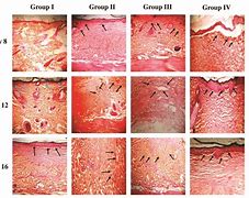 Image result for Periungual Granulation Tissue