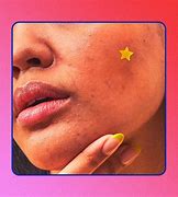 Image result for Bumps On Skin That Look Like Pimples