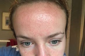 Image result for Rash On Forehead