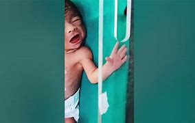 Image result for Anencephaly Nicu Baby
