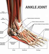 Image result for Broken Right Ankle