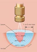 Image result for Actinic Keratosis Cryotherapy