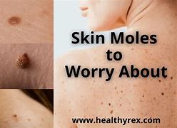 Image result for Moles Above-Knee