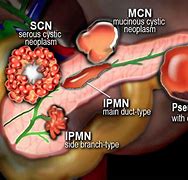 Image result for Benign Tumor On Pancreas