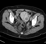 Image result for Fibroid Cysts in Uterus