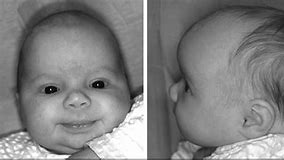 Image result for Craniosynostosis