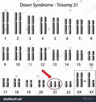 Image result for karyotype+down