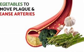Image result for Removing Plaque From Arteries