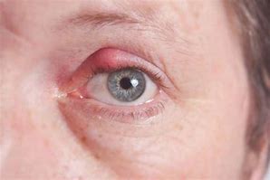 Image result for Nodules On Eyelid