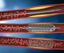 Image result for Carotid Angioplasty without Stenting