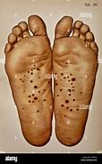 Image result for Syphilis Rash On Foot