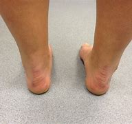 Image result for Excess Pronation