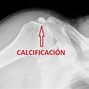 Image result for calcificad