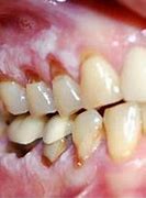 Image result for Gingival Cancer Pictures