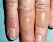 Image result for 1st Degree Burn Treatment