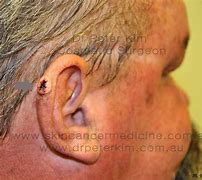 Image result for Basal Cell On-Ear Cartilage