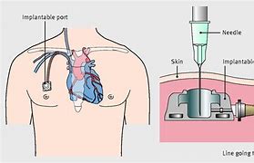 Image result for How Make Central Venous Catheter
