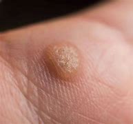 Image result for Common Warts