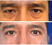 Image result for blefaroplastia