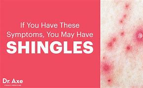 Image result for Shingles Stomach