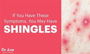 Image result for Shingles Early Stages