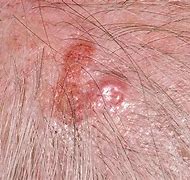 Image result for Basal Cell Carcinoma Superficial Nodular Type