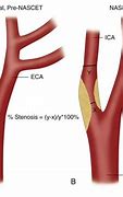 Image result for Internal Carotid Artery Ultrasound
