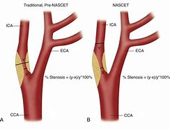 Image result for Carotid Artery X-ray