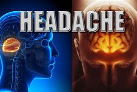 Image result for Headache On Crown of Head